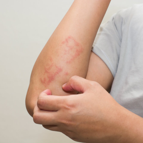 Dermatite atópica no SUS: Psoríase Brasil cobra acesso a tratamentos já incorporados em PCDT